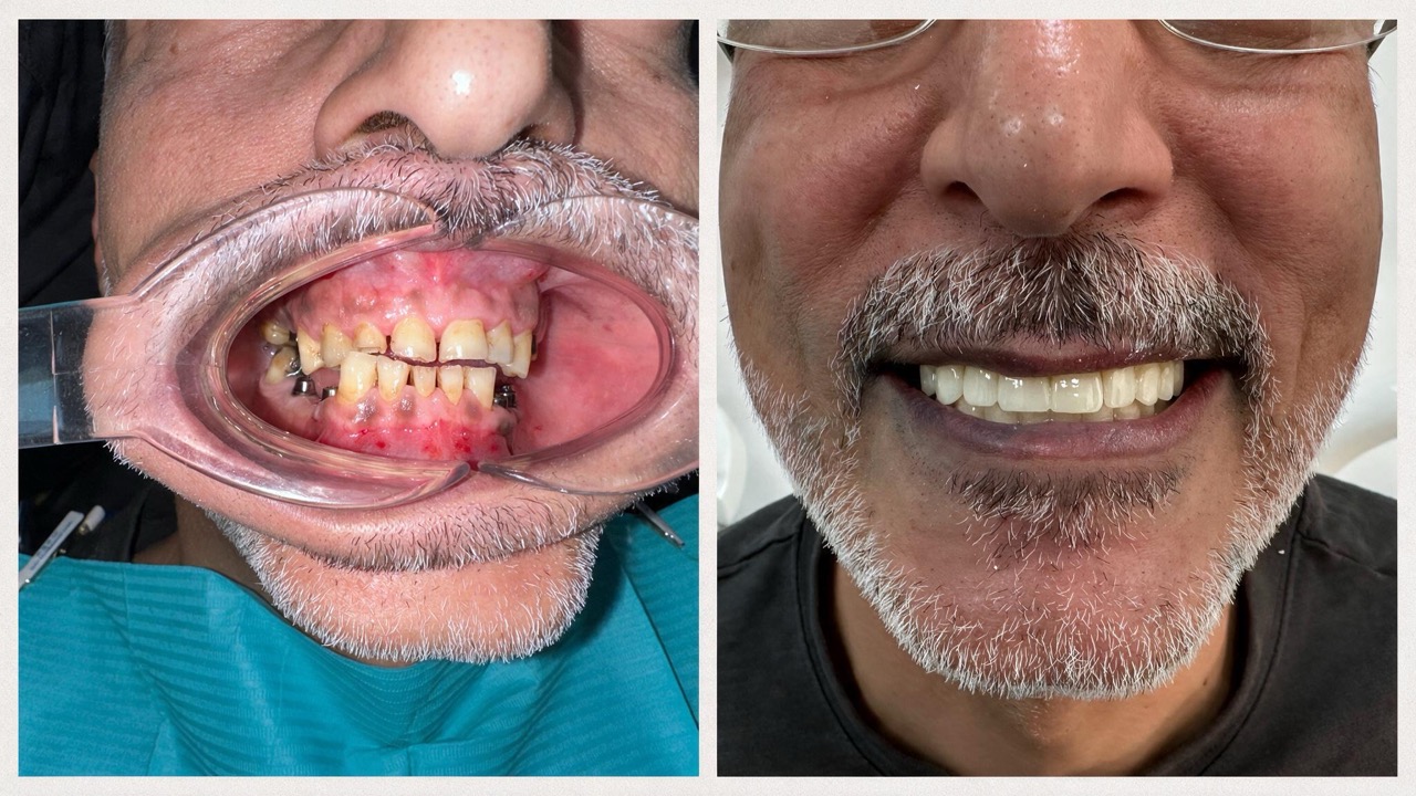 Antes y después de un tratamiento de implantes dentales en Clínica Sector Dental