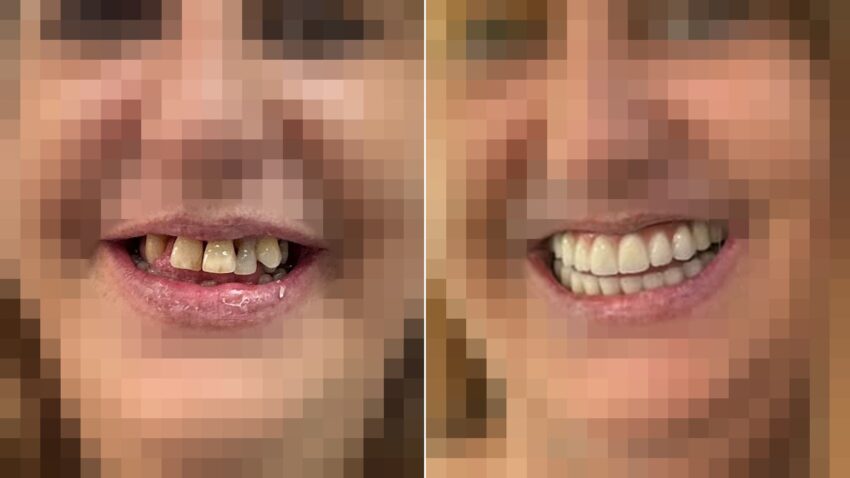 Antes y después de implantes dentales con tornillo en Sector Dental, Madrid