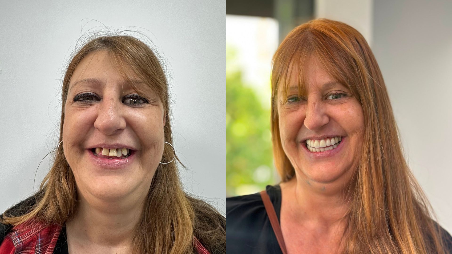 Antes y después de implantes dentales en Madrid de una paciente de Clínica Sector Dental