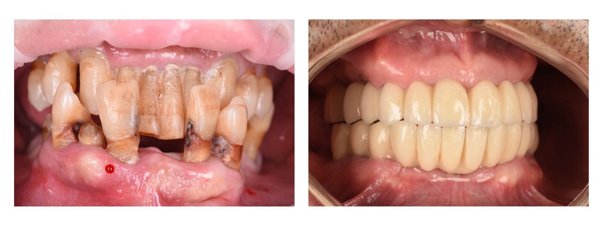 Antes y después de rehabilitación con implantes dentales en Clínica Sector Dental, Campamento
